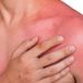 日焼けが痛いときの対処法や赤いのを治す方法とは？